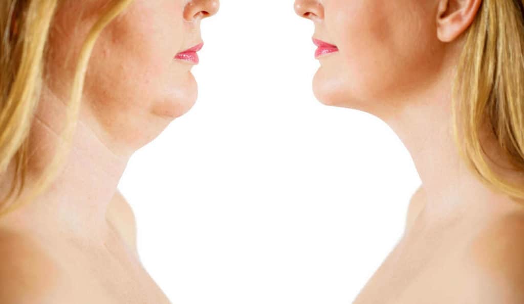 Double Chin treatment Taunton before and after results