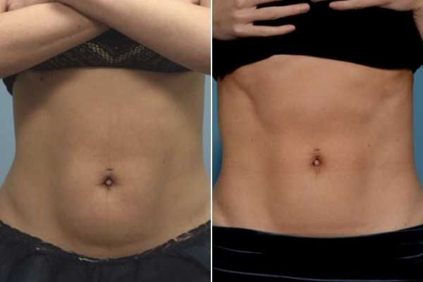 body sculpting FAQs Taunton