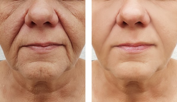 Learn more about Morpheus8 Treatment Taunton today!