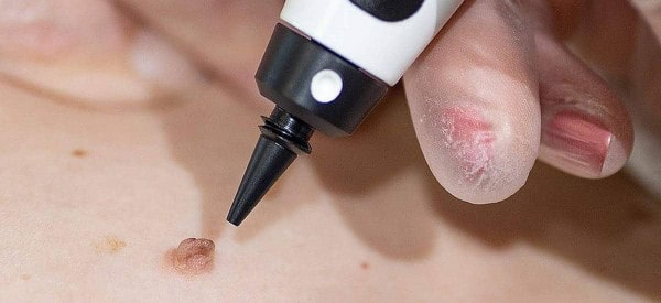 After Skin Tag Removal Taunton