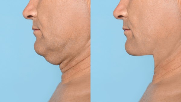 Which Non-Surgical Treatments Work Best for Jowls and Loose Skin Taunton?
