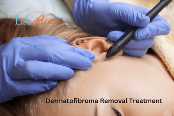 Dermatofibroma Removal Treatment Taunton