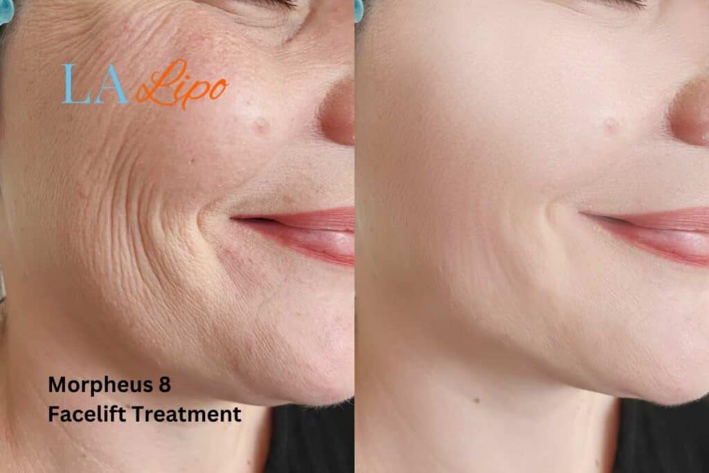 Morpheus8 Treatment Taunton for flawless skin! Call us today!