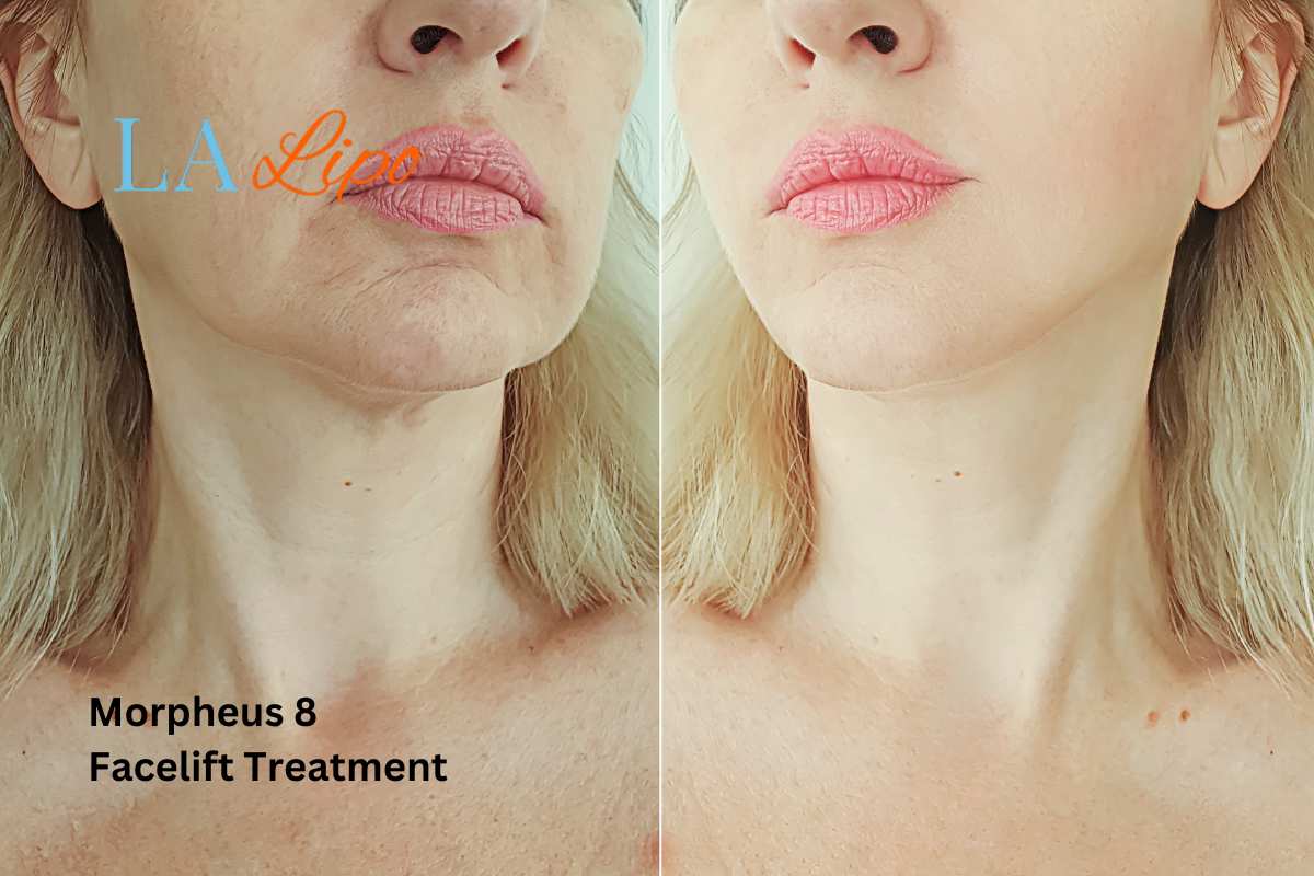 Turn back time with Morpheus8 Treatment Taunton