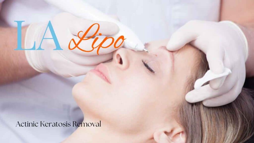 actinic keratosis removal Taunton