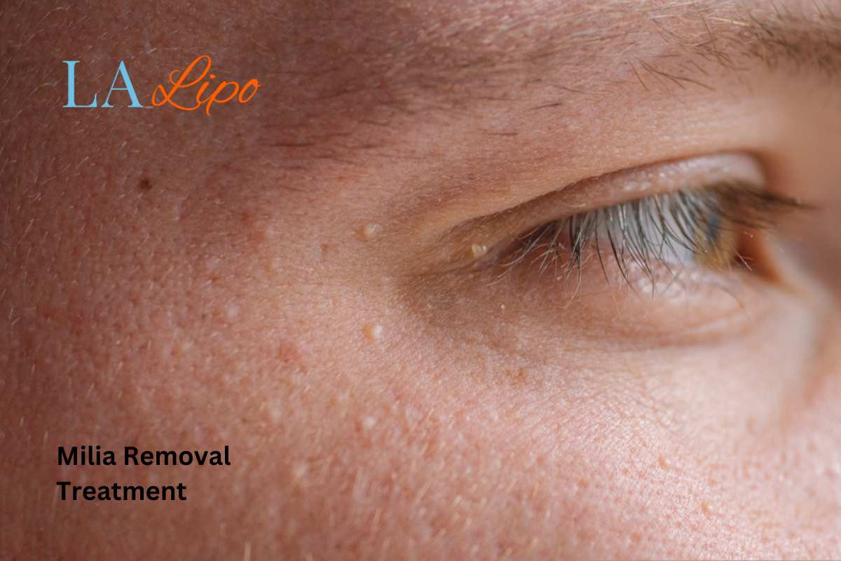 Cryopen Milia Removal: Is It the Easiest and Safest Option Taunton?