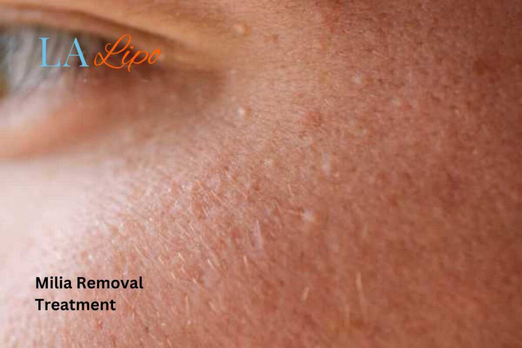 milia removal