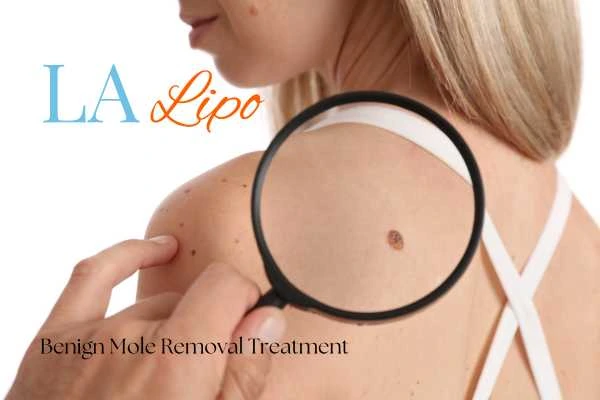 Woman having her inspection of blemish before mole removal Taunton