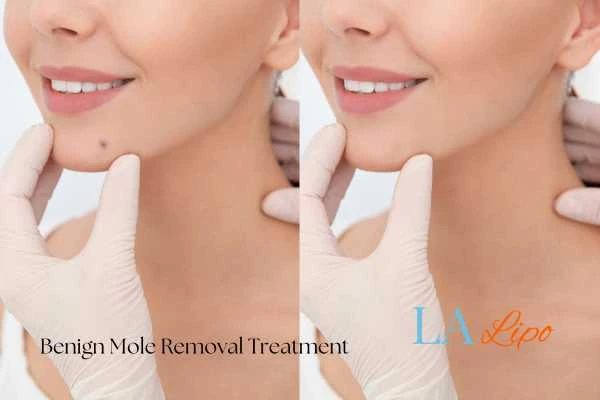 Before and after mole removal Taunton treatment
