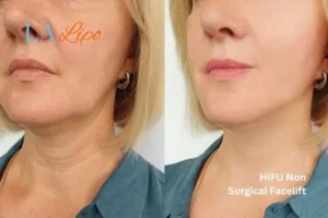 hi-fu for wrinkles Taunton before and after results
