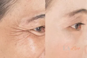 Before and after results of woman - HI-fu wrinkles reduction treatment Taunton