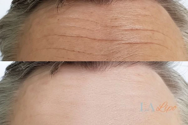 results of HIFU Taunton on mans forehead to help reduce lines and wrinkles