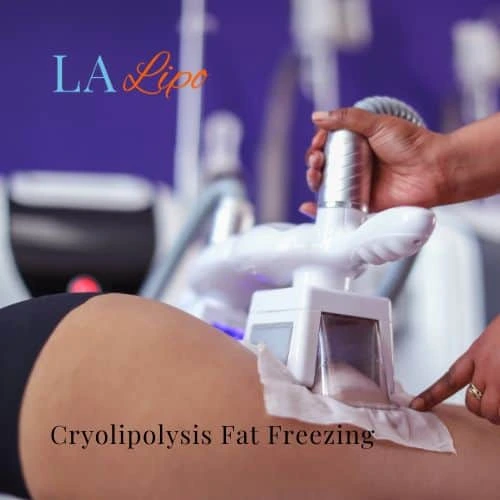 fat freezing - Cryolipolysis Taunton