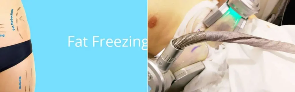 Fat freezing Taunton on multiple areas of the body