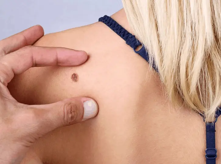 woman having mole removal Taunton consultation before treatment.