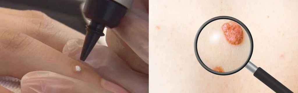 Person getting moles removed with cryopen Taunton