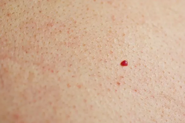 close up of a cherry angioma Taunton