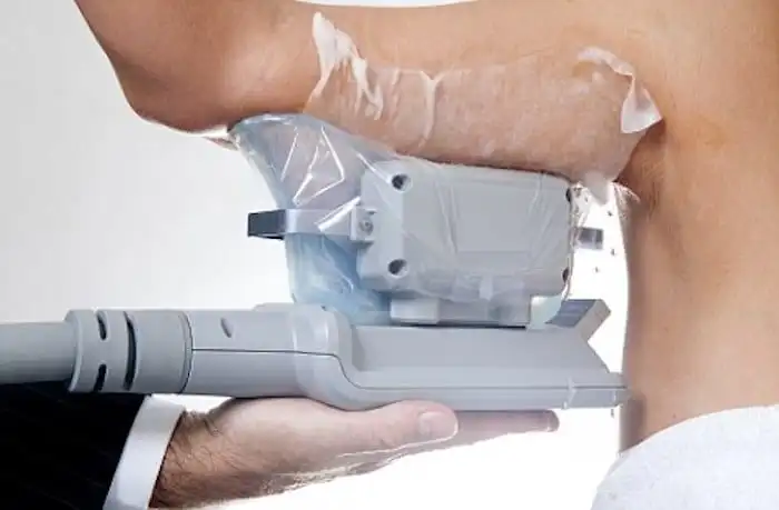Picture of fat freezing Taunton on the upper arms.