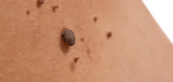 image of a skin tag Taunton