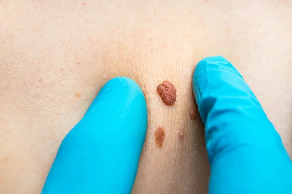 Consultant examining a skin tag Taunton