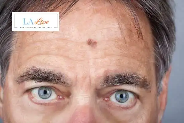 Solar Lentigo Removal Taunton image of man with mark on his forehead