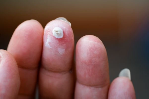wart on person finger - cryotherapy to treat from LA LIPO Taunton
