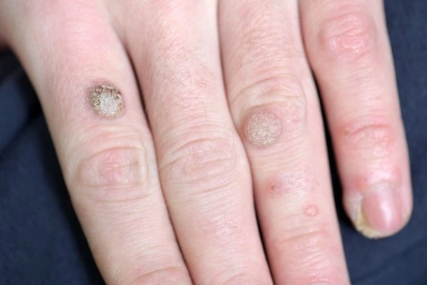 photo of warts on person hand - see wart removal Taunton from LA LIPO