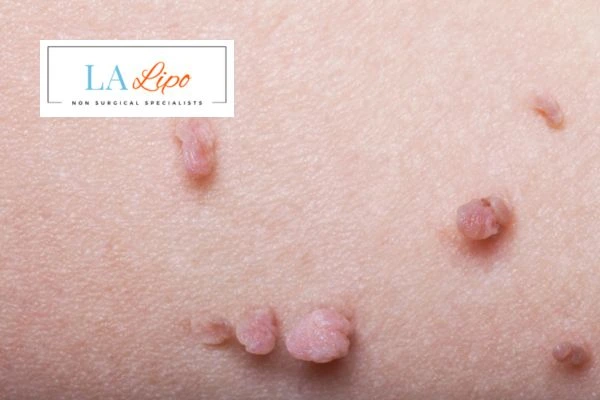 Does cryopen skin tag removal Taunton hurt? Find out now call our team today!