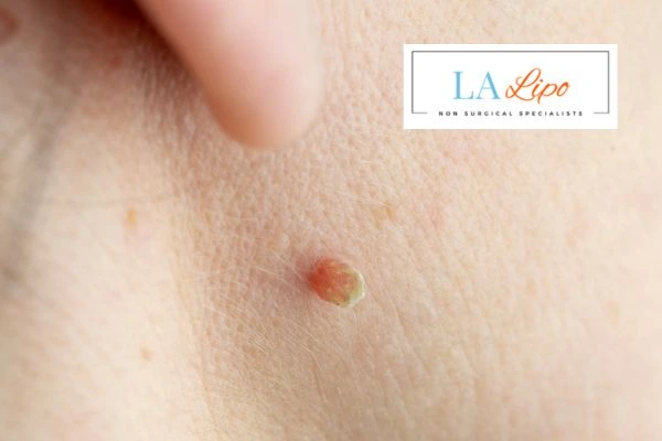 Book skin tag removal Taunton today speak to our team now!