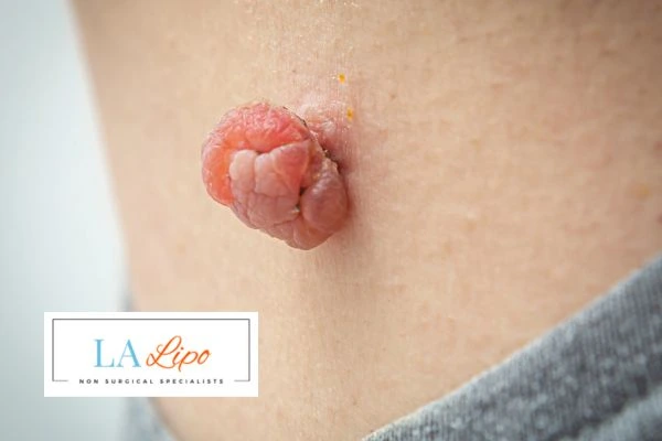 Interested in skin tag removal Taunton? Concerned about the pain? Find out more today!
