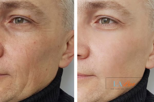 See the amazing results of Morpheus8 Treatment Taunton!