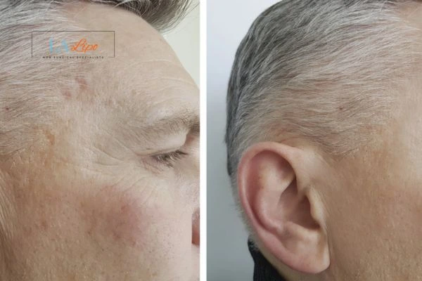 Mens Before & After Morpheus 8 Results Taunton