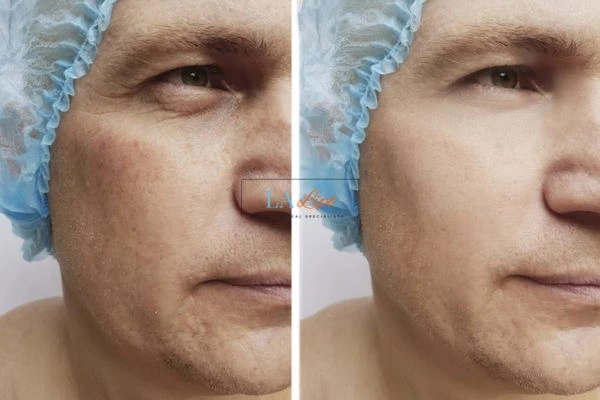 Before and after Morpheus 8 Results Taunton