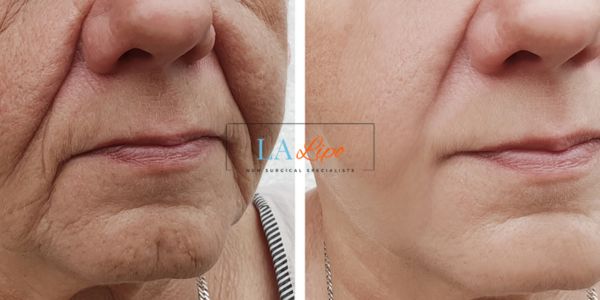 Older lady deeper wrinkle reduction - LA LIPO Morpheus 8 Results Taunton
