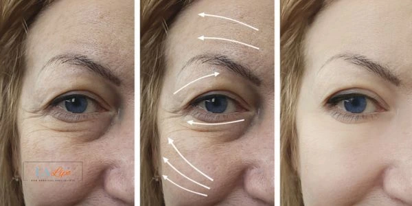 Amazing eye lift Morpheus 8 results Taunton