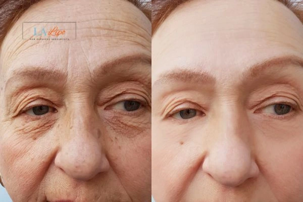 The powerful benefits of Morpheus8 Treatment Taunton - Call Our team today!