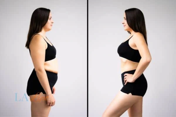 Picture of womans before and after using LA-EMS body sculpting to improve her core strength Taunton