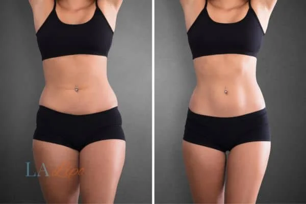 before and after results of non-surgical treatment to help a woman's body image and mental health Taunton