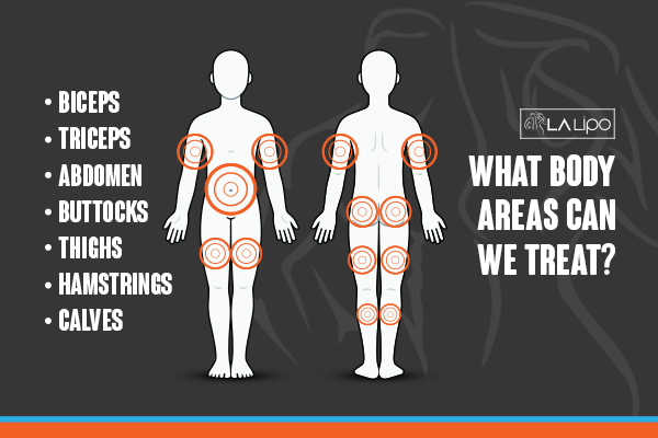 Diagram to show areas you can have LA-EMS Body Sculpting Treatment Taunton