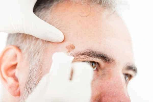 Age spots and elderly people Taunton what is the link?