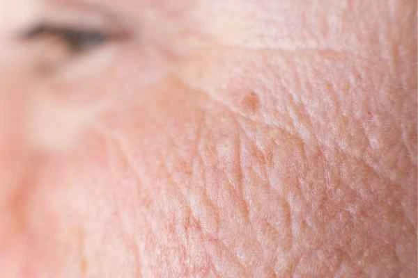 close up picture of a woman's face showing an age spot Taunton
