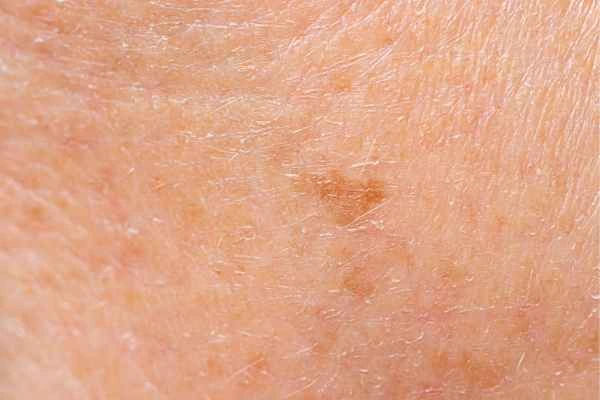 close up picture of age spots Taunton