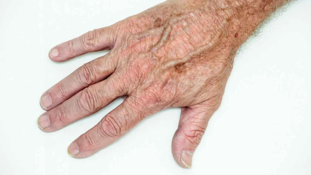 Male hand showing age spot Taunton