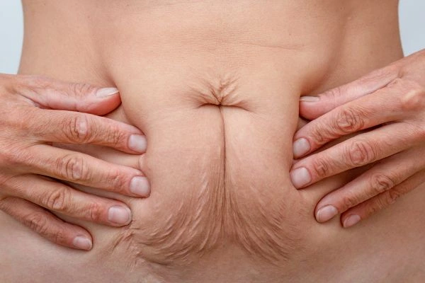 Image of a woman's stomach with loose skin - example of skin tightening Taunton options