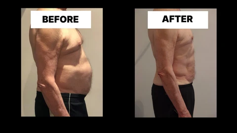 What Symptoms Can Diastasis Recti Cause in Men? Weak Core, Back Pain and Poor Posture Taunton